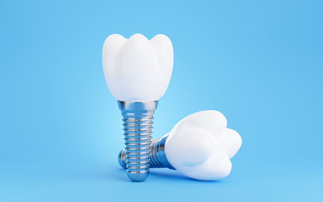 Are Dental Implants Right for Me?